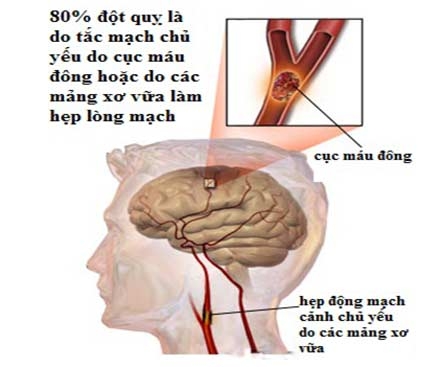 bệnh tai biến mạch máu não, còn gọi là đột quỵ