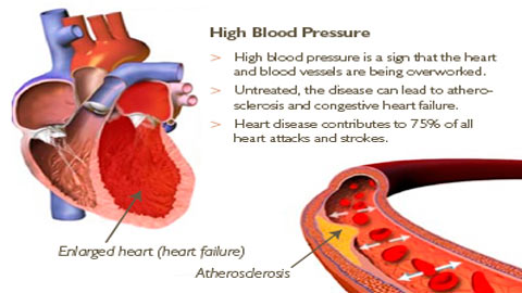 Sự ảnh hưởng của cao huyết áp đến cơ thể