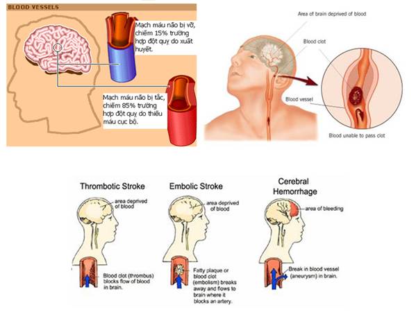 Xuất huyết não bắt nguồn từ đâu? 