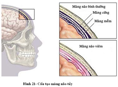 Viêm màng não