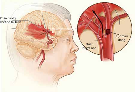 Vỡ mạch máu hoặc tắc mạch máu là nguyên nhân gây tai biến mạch máu não
