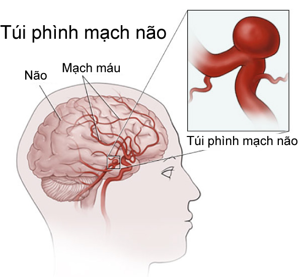 Dị dạng mạch máu não là gì? Nguyên nhân và cách chữa trị 