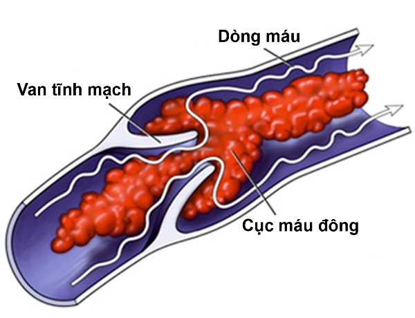 Thuốc kháng đông giúp phòng ngừa tắc mạch máu não