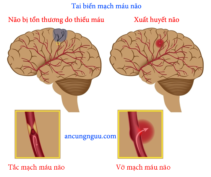 Các dạng tai biến mạch máu não