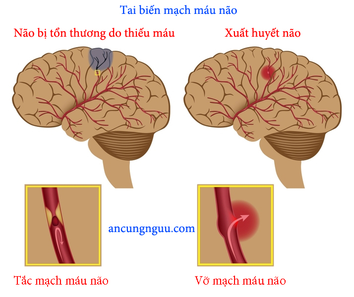 Tai biến mạch máu não là gì? 