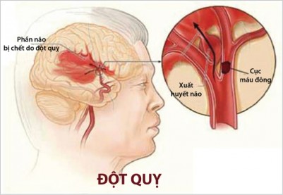 Những lưu ý khi dùng sản phẩm phòng ngừa đột quỵ 