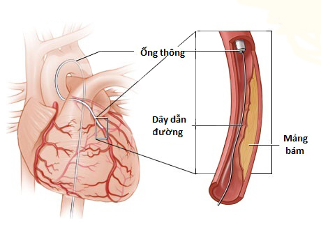 Bệnh tim mạch vành