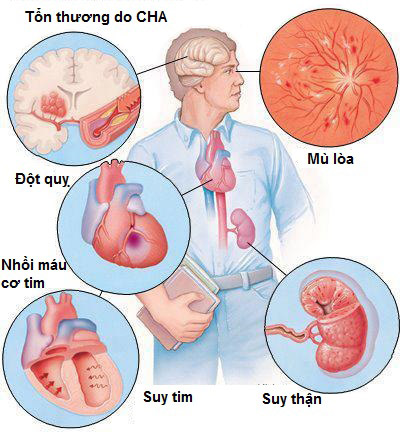 Các biến chứng bệnh tăng huyết áp