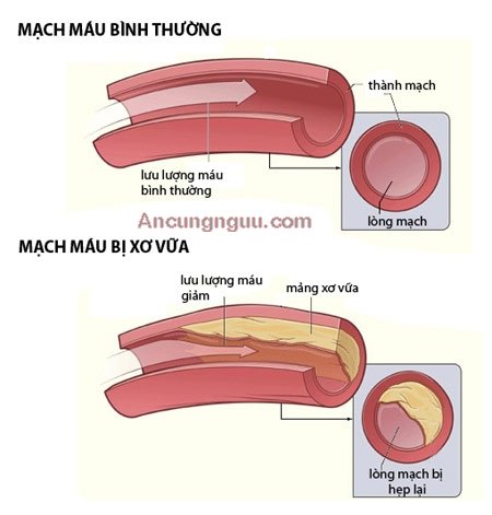 Biến chứng tăng huyết áp với sơ vữa động mạch