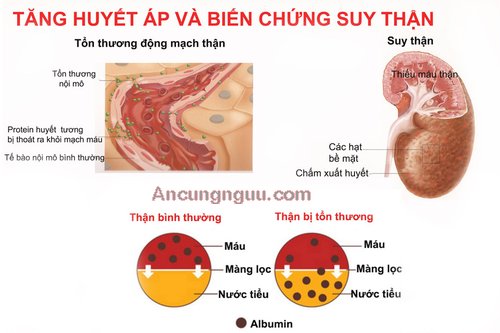 Biến chứng tăng huyết áp với bệnh về thận