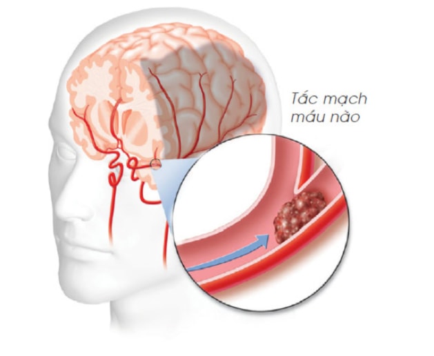 kien nao hoan han quoc Tai biến mạch máu não là mối nguy hiểm thường trực