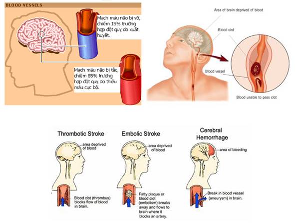 Những triệu chứng và cách phòng bệnh tai biến mạch máu não hiệu quả
