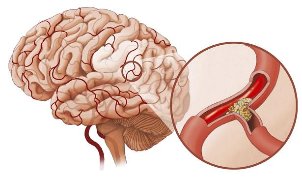 Chế độ ăn cho người bị tai biến mạch máu não 