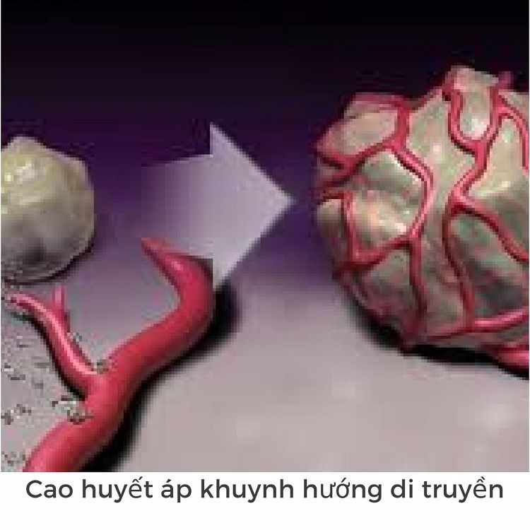 Cao huyết áp có khuynh hướng di truyền