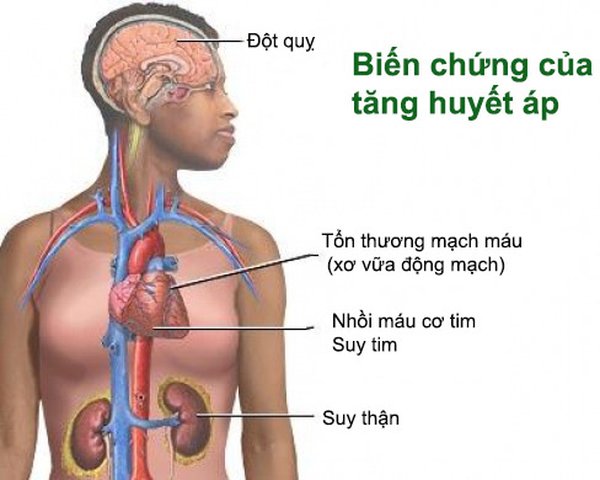 Một số biến chứng của bệnh cao huyết áp Một số biến chứng của bệnh cao huyết áp